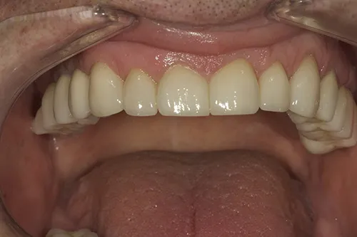 3 month review of upper teeth