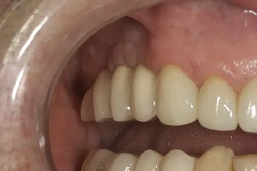 3 month review of implant restorations