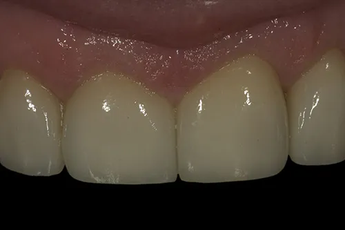 3 month review close up of permanent front crowns