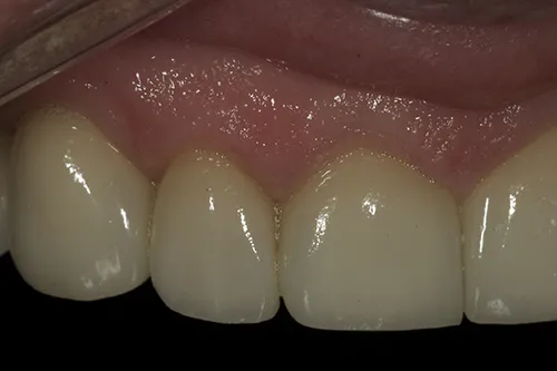 3 month review close up of upper front right crowns