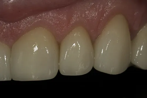 3 month review close up of upper front left crowns