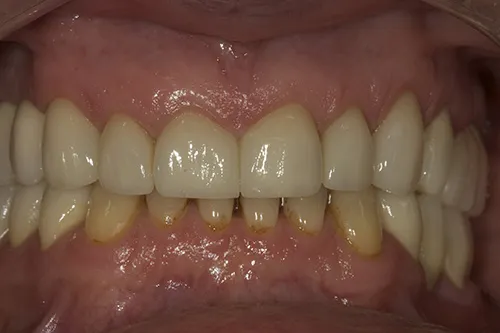 After treatment: Restoring worn and missing teeth with implants and crowns