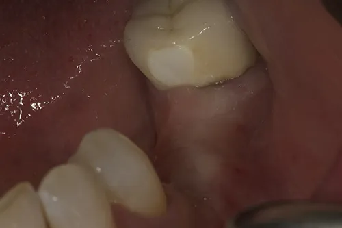 Before treatment: Replacing missing teeth with screw-retained implant crowns