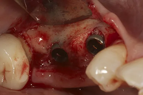 Implants placed with carriers removed