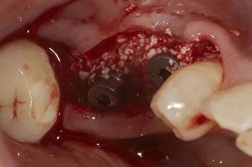 Implants in situ with guided bone regeneration (bone substitute build-up)