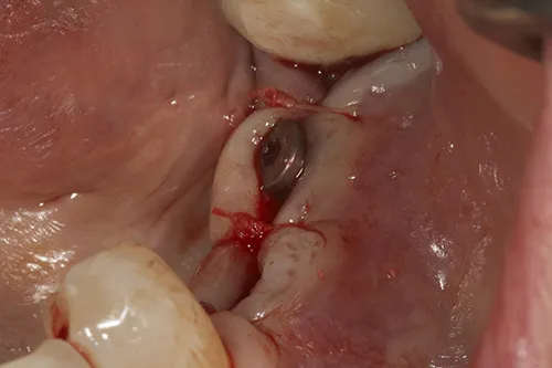 Closed implant site with metal healing abutments