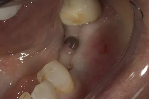 Healing abutments healed in situ 6 weeks later pre exposure