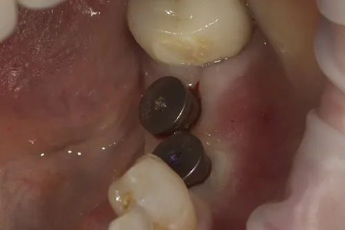 Wider healing abutments used to develop emergence profile