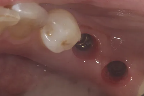 Emergence profile of implant fixtures