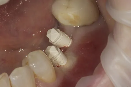 iTero scan bodies attached to implant fixtures
