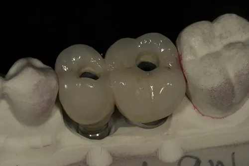 Screw retained permanent crowns on iTero model