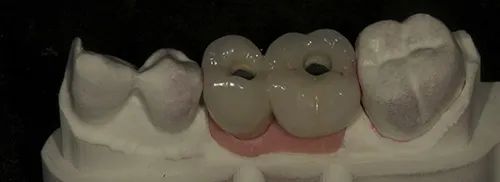 Permanent crowns with iTero soft tissue model