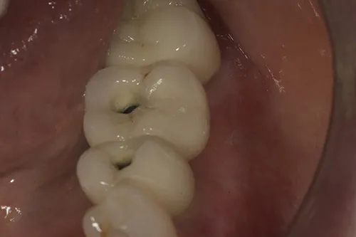 Screw-retained permanent crowns tried in situ