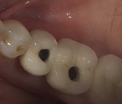 Screw-retained permanent crowns in situ, showing the screw access hole