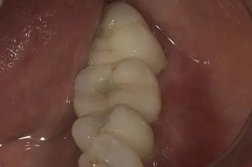 After treatment: Replacing missing teeth with screw-retained implant crowns