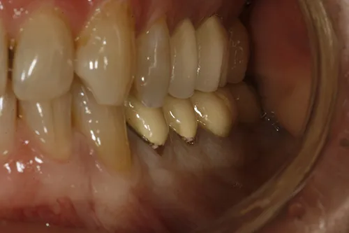 Before treatment: Replacing failing lower crowns with implant crowns