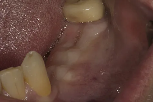 Healed site following extractions