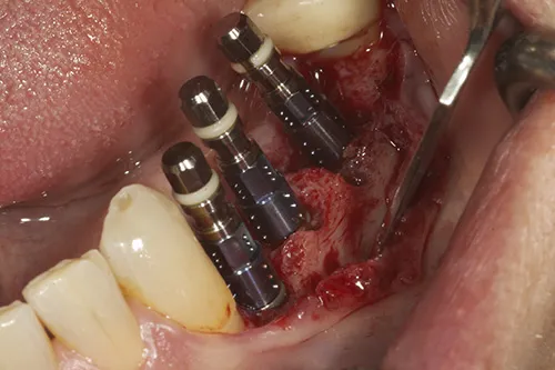 Implants placed in situ