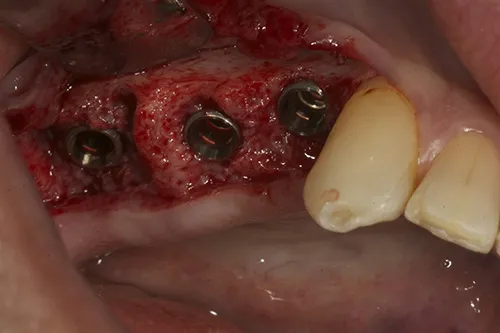Implants in situ from above