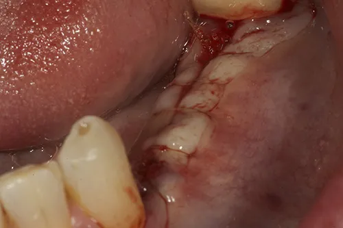 Closed implant site