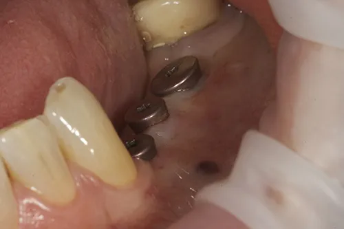 Healing abutments in situ before the digital scan was taken