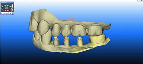 Digital iTero scan of both upper and lower