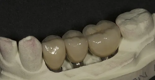 Implant crown restorations in place