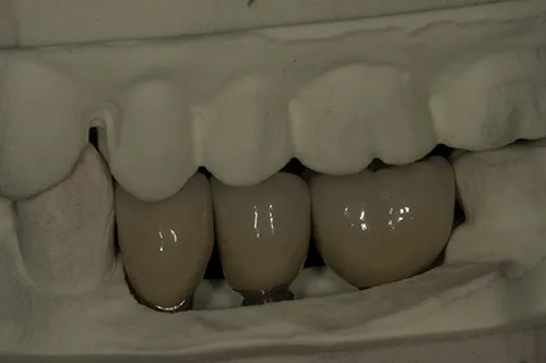 Implant crowns on models