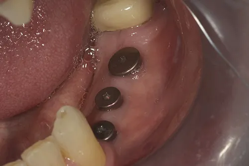 Healed sites prior to connection of implant crowns