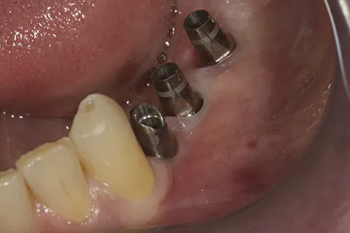 Permanent abutments in situ