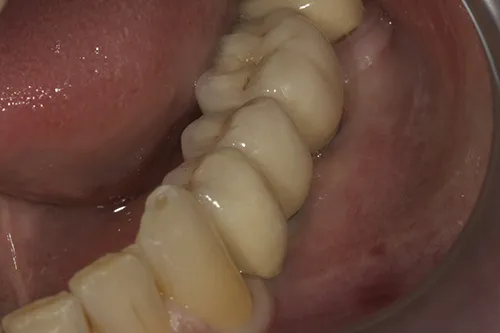 After treatment: Replacing failing lower crowns with implant crowns