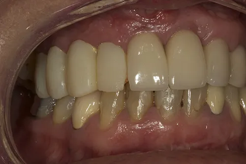 Before treatment: Replacing a failing implant bridge