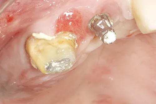 Failing implant placed 15 to 20 years earlier, which was connected to a loose tooth through bridgework