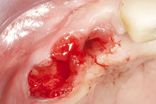 Failed implant and tooth extracted