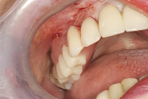 Temporary denture fitted immediately