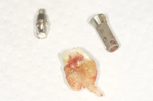 Implant and tooth carefully and gently removed