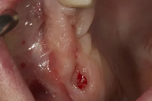 Healed extraction site