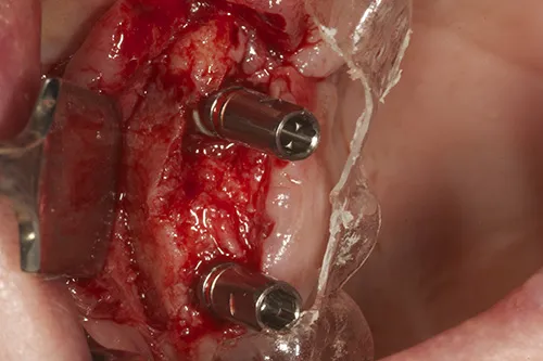Implants placed in situ
