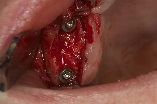 Implants with cover screws ready to be buried under the gum