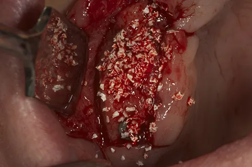 Guided bone regeneration to build out the width of the tissues for a better aesthetic result