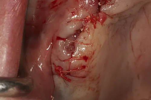 Implant site sutured closed