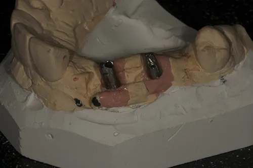 Following first stage impressions at surgery models have been poured and permanent abutments chosen