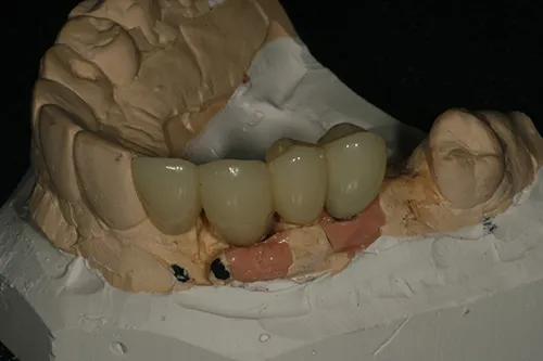 Implant supported temporary bridge made
