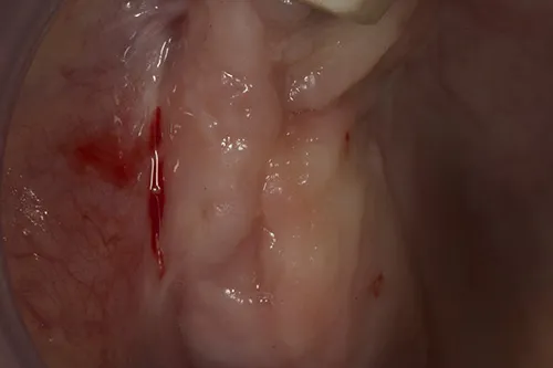 Healed site prior to fixture exposure