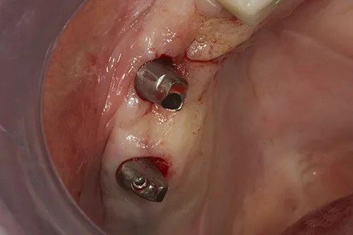 Permanent abutments tried in