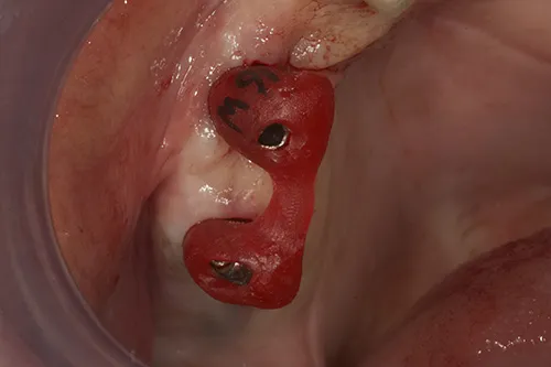 Permanent abutments tightened in precise position using an acrylic jig