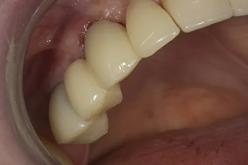 Temporary bridge used to develop the emergence profile of the teeth (how they come out of the gum)