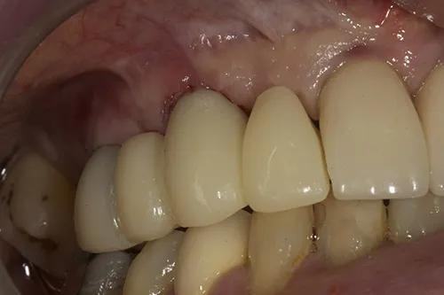 Temporary acrylic bridge 2 weeks later