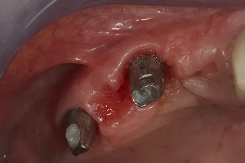 Fully developed emergence profile of permanent abutments