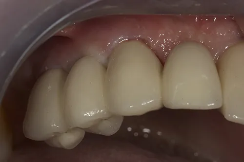 After treatment: Replacing a failing implant bridge